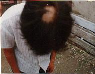 图：李秀文的头发被恶警贾宝臣撕掉一大把