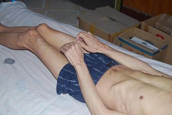 邵承洛肋部被鞋刷子捣烂感染，全身肌肉萎缩体重不足90斤