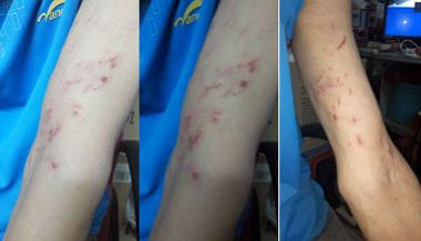 郭倡材双手臂被铐肿、铐伤